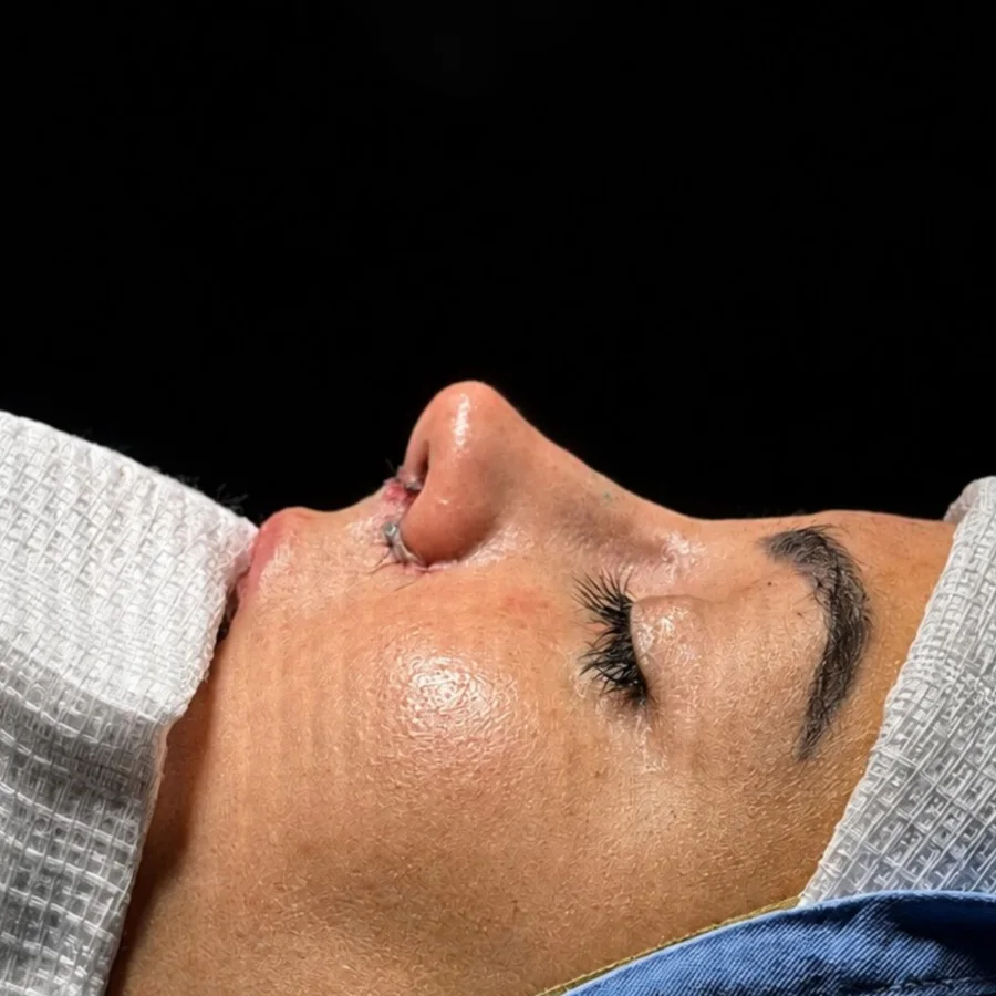Perfil do nariz depois da rinoplastia
