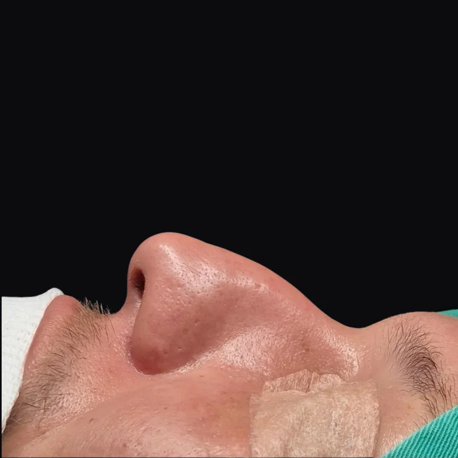 Perfil do nariz antes da rinoplastia