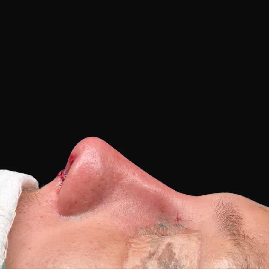 Perfil do nariz depois da rinoplastia
