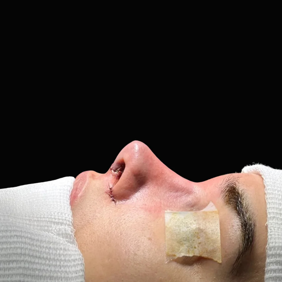 Perfil do nariz depois da rinoplastia